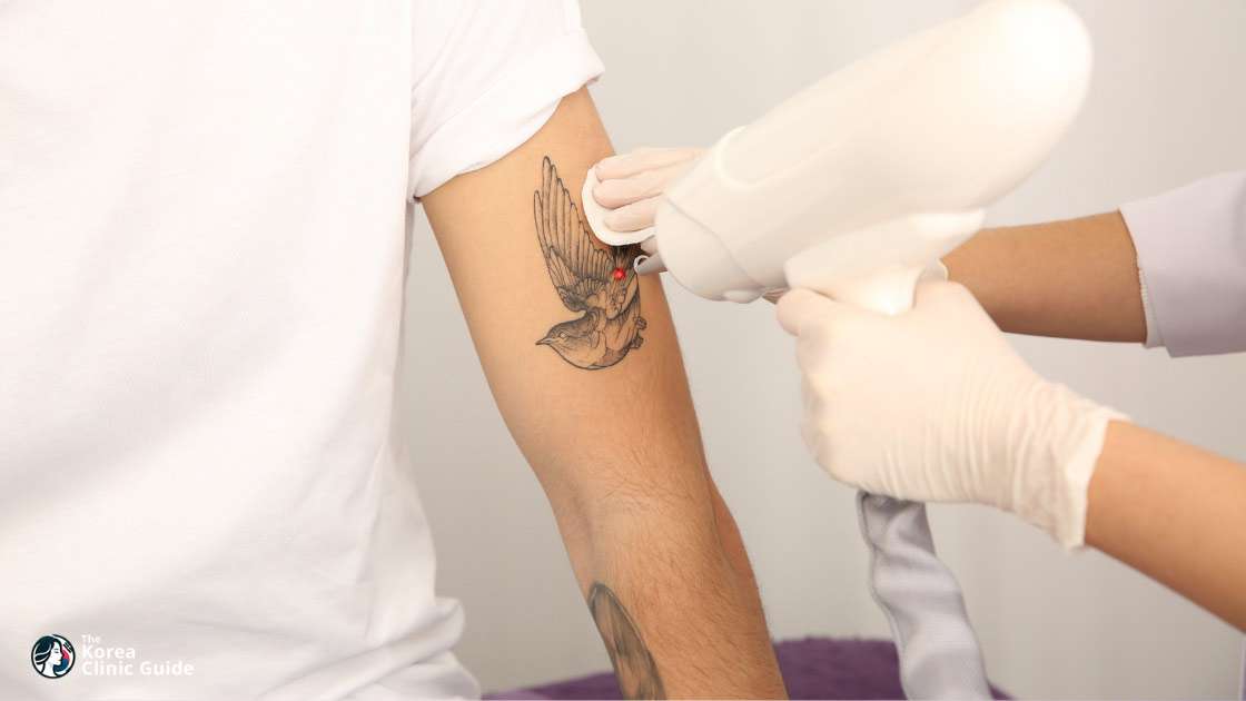 Laser-Tattooentfernung in Korea (Seoul) | Die besten Kliniken, Kosten, Behandlungsmethoden und mehr