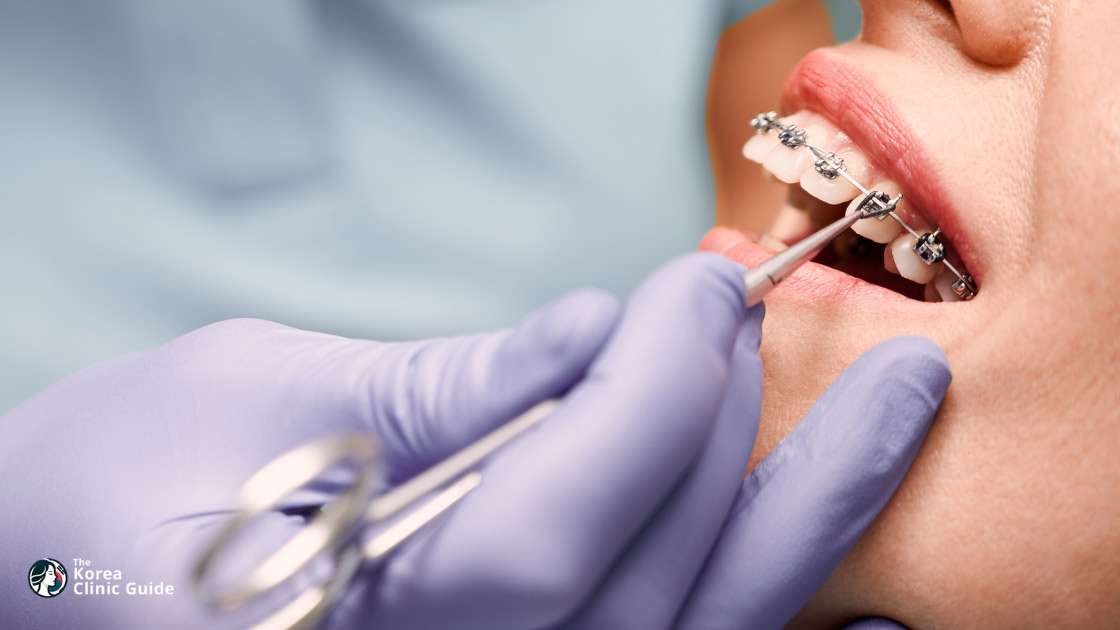 Clippy-C-Zahnspangen in Südkorea | Die besten Kliniken, Kosten, Behandlungsoptionen und mehr