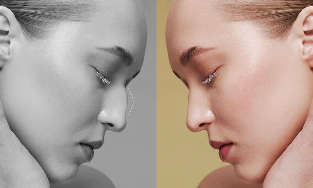 Revision Rhinoplasty in Korea | Best Clinics, Costs, Procedure Types & More