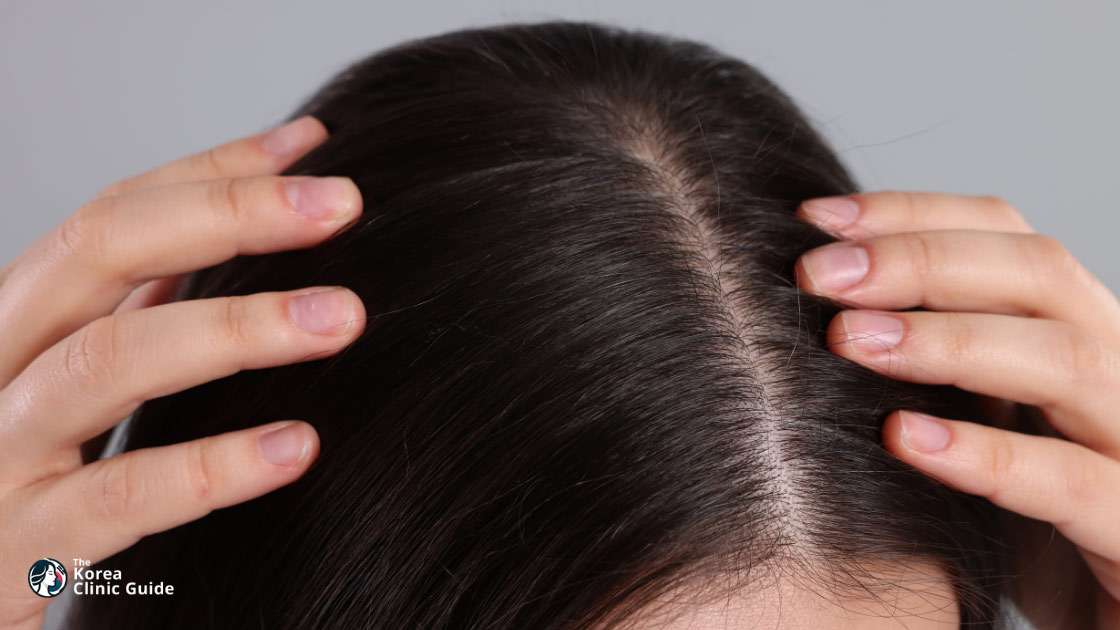 Stammzelltherapie für die Kopfhaut in Korea | Die besten Kliniken, Kosten, Behandlungsarten und mehr