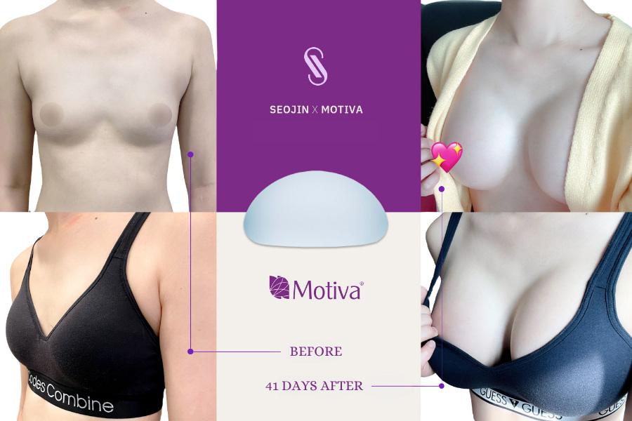 Before and After Breast Augmentation