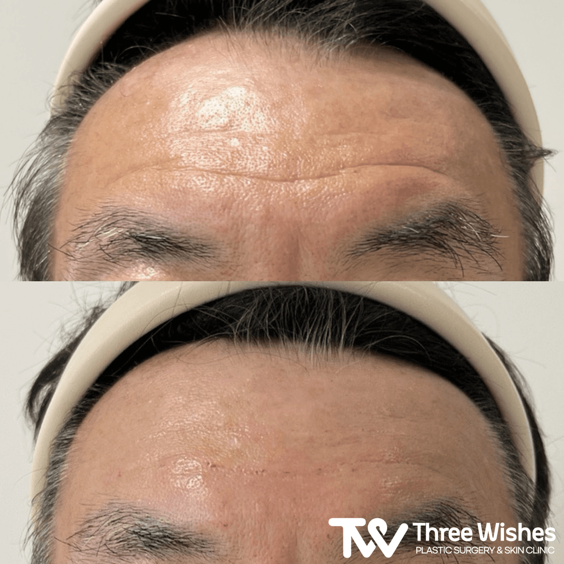 Before and After Forehead Filler