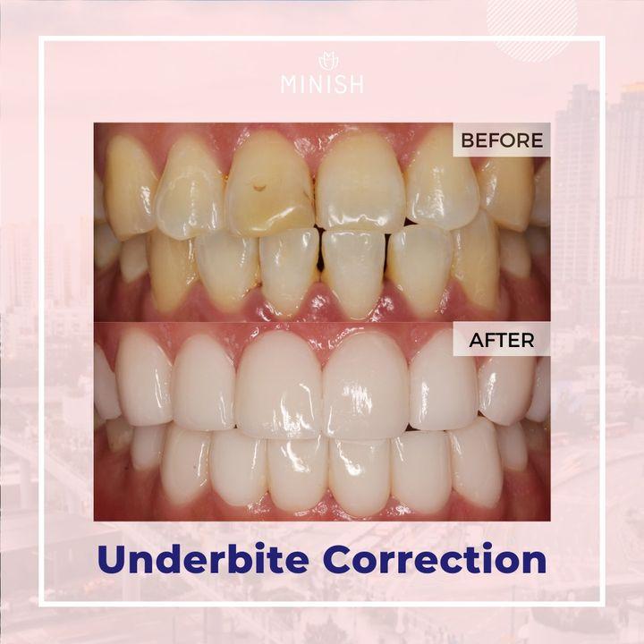 Before and After Veneers