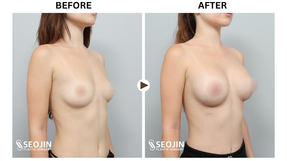 Before and After Breast Implant