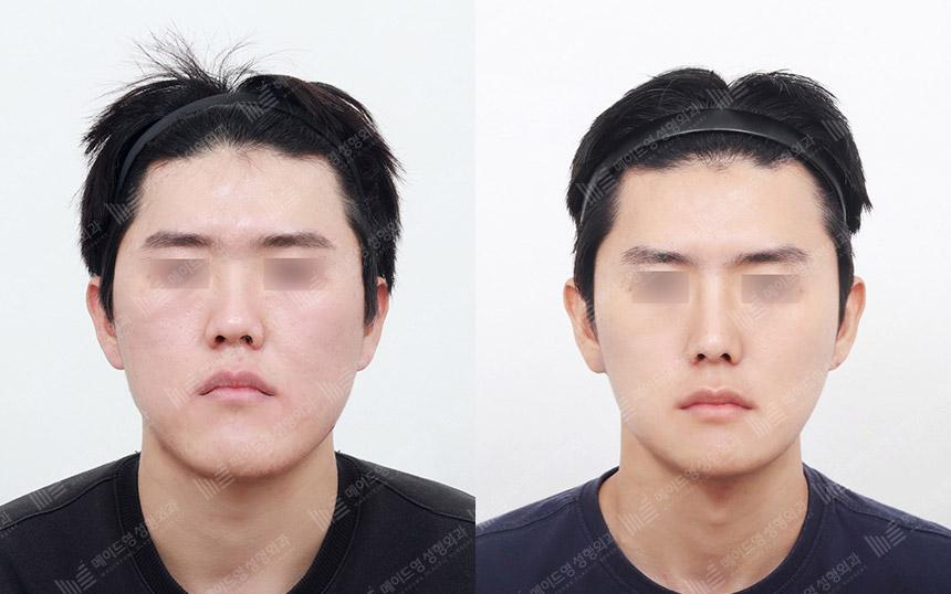 Before and After Face Contouring