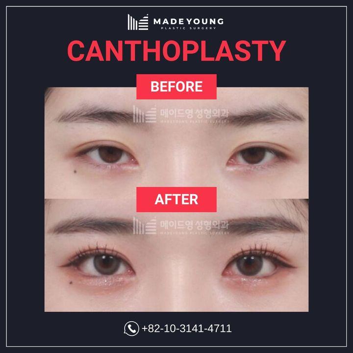 Before and After Canthoplasty