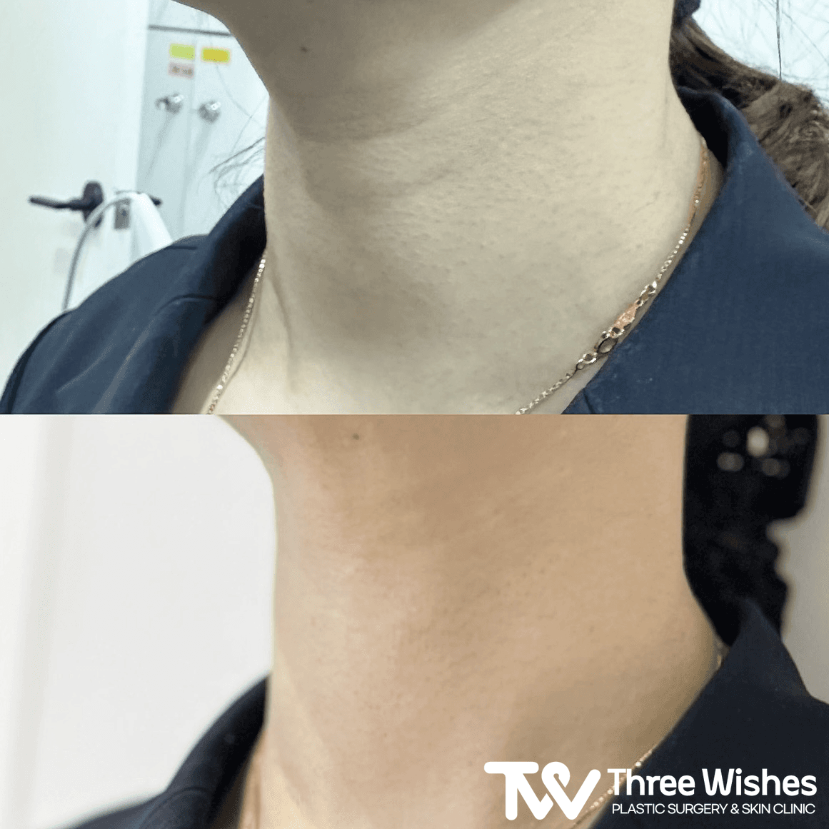 Before and After Neck Wrinkle Treatment