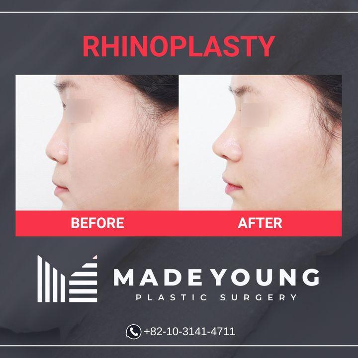 Before and After Rhinoplasty