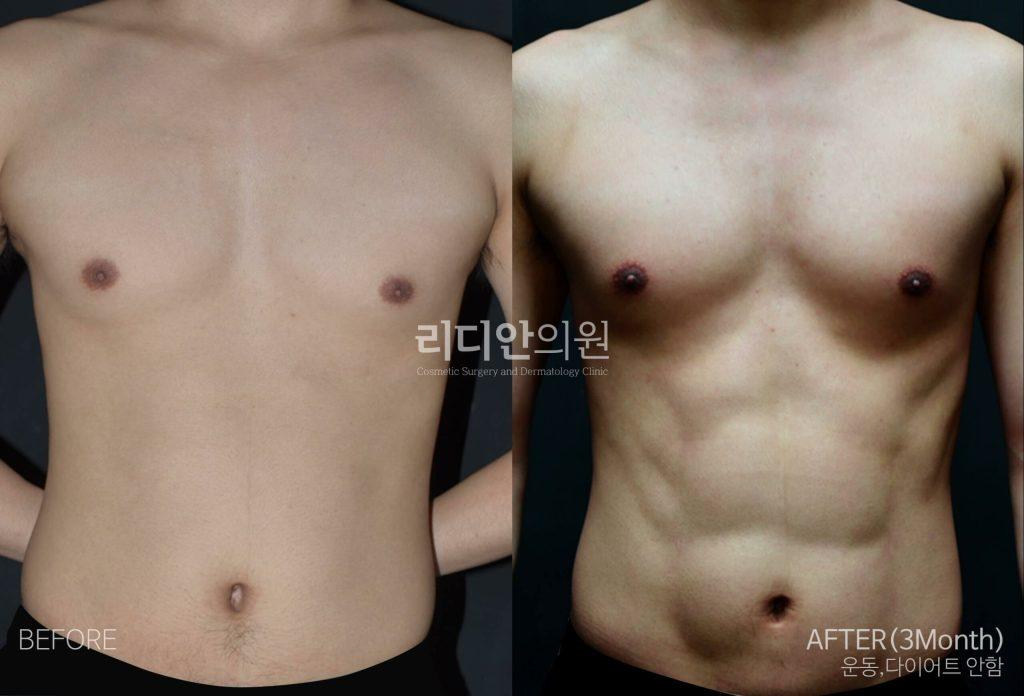 Before and After 5D Liposculpture