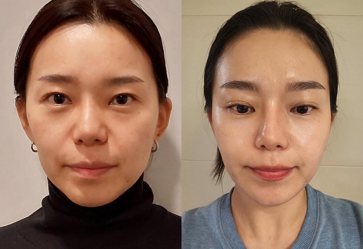 Before and After Thread Lift