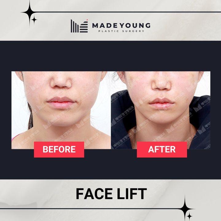 Before and After Face Lift