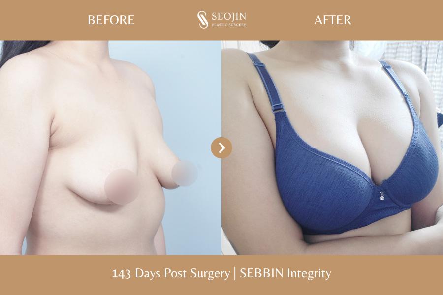 Before and After Breast Augmentation