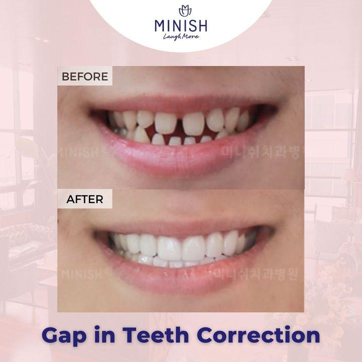 Before and After Veneers