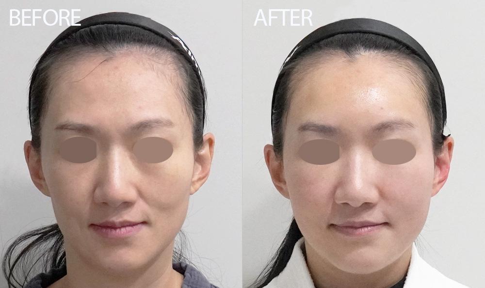 Before and After Stem Cell Fat Grafting