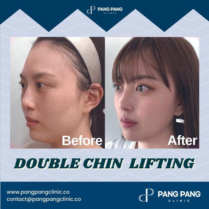 Before and After Double Chin Tightening