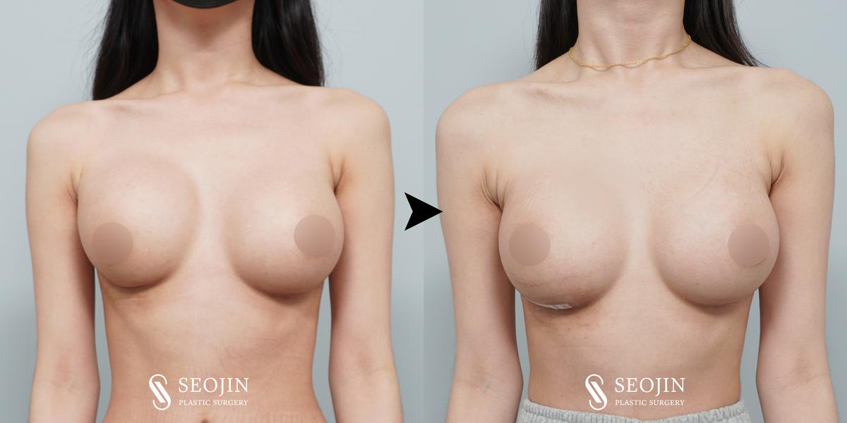 Before and After Revision Breast surgery