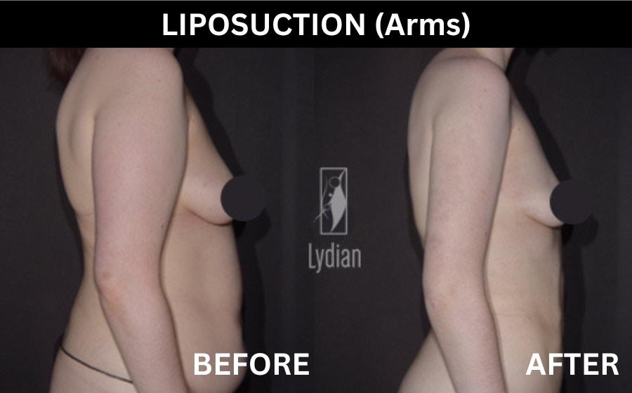 Before and After Arm Liposuction