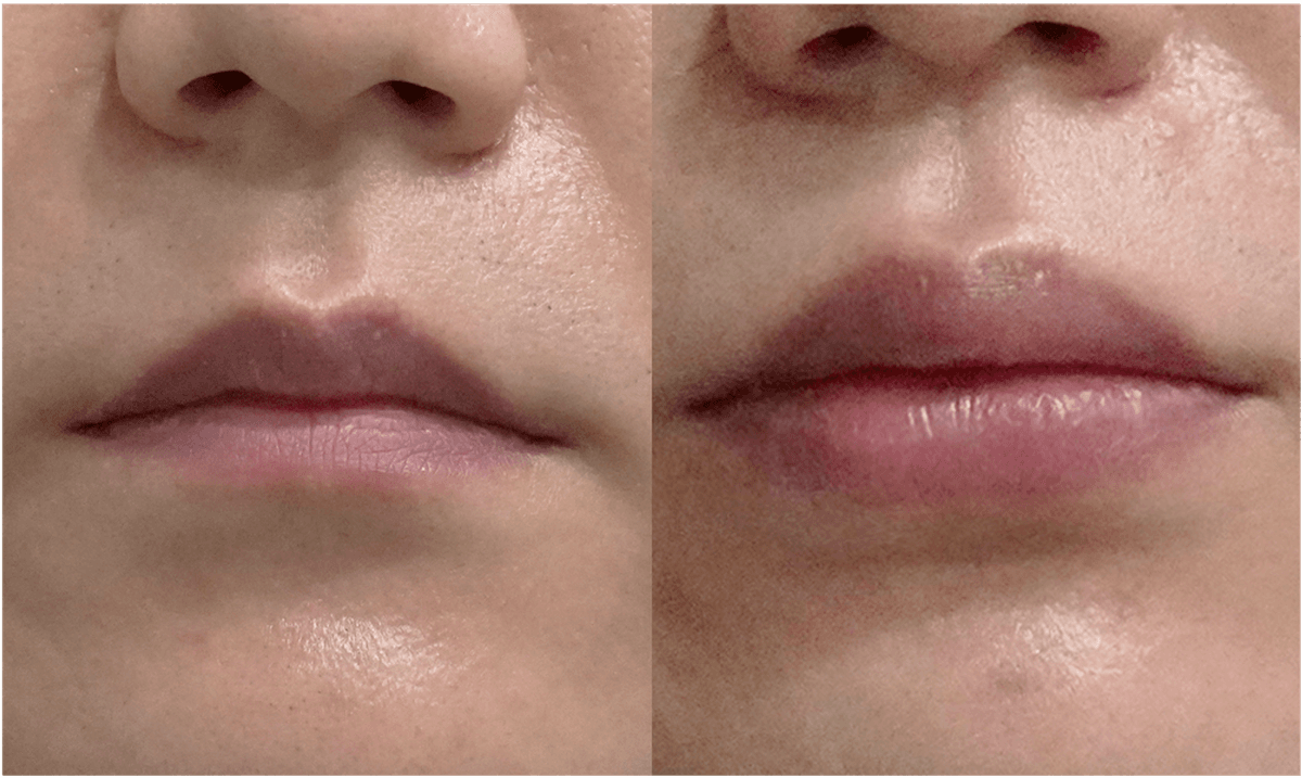 Before and After Face Fat Grafting