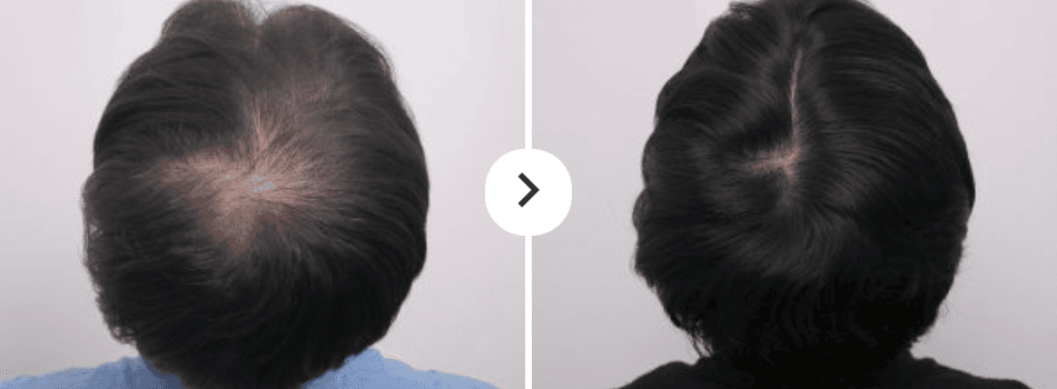 Before and After Hair Loss Treatment