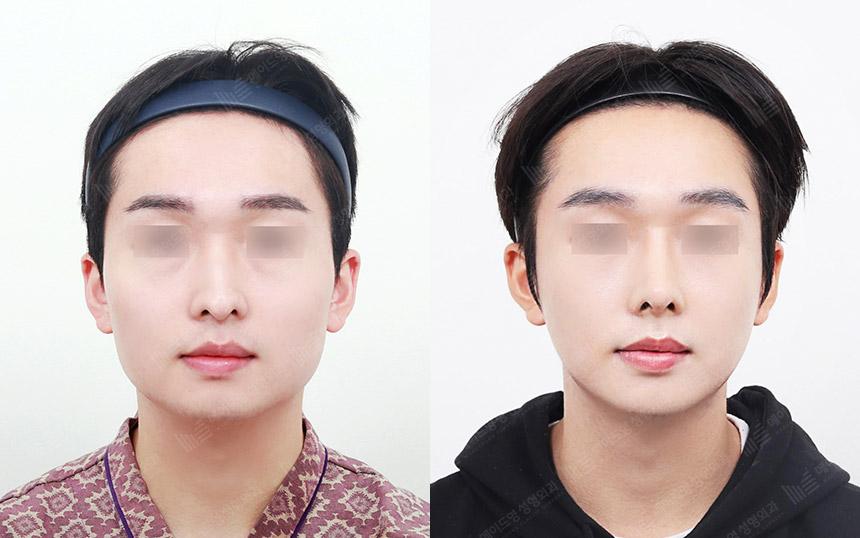 Before and After Face Contouring