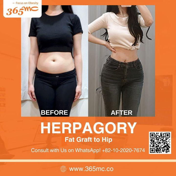 Before and After Body Fat Grafting