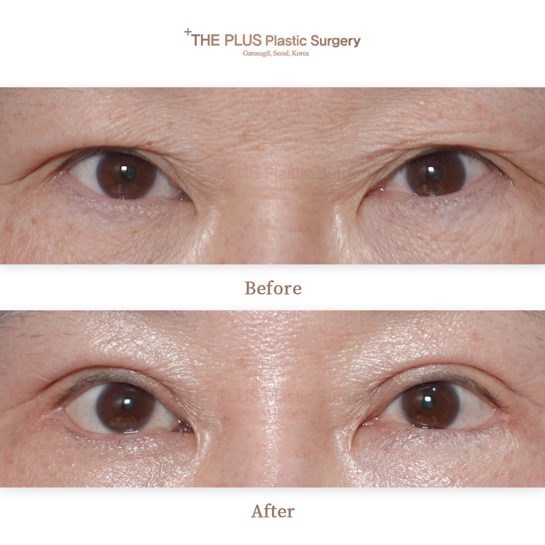 Before and After Blepharoplasty