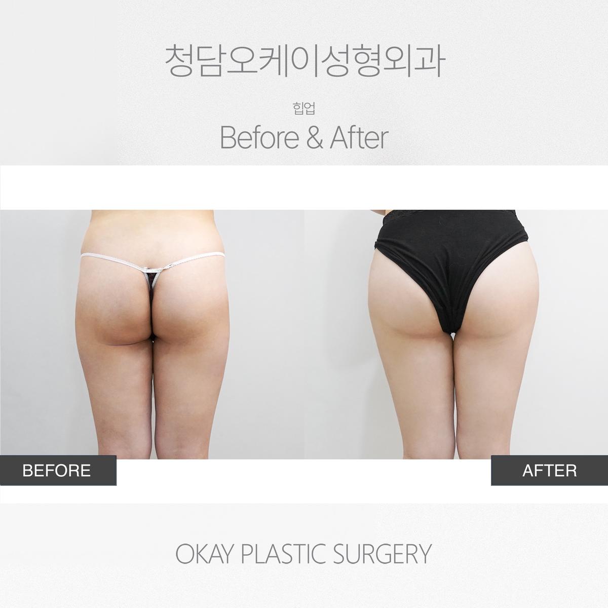 Before and After Brazilian Butt Lift