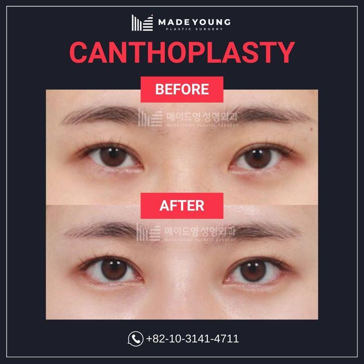 Before and After Canthoplasty