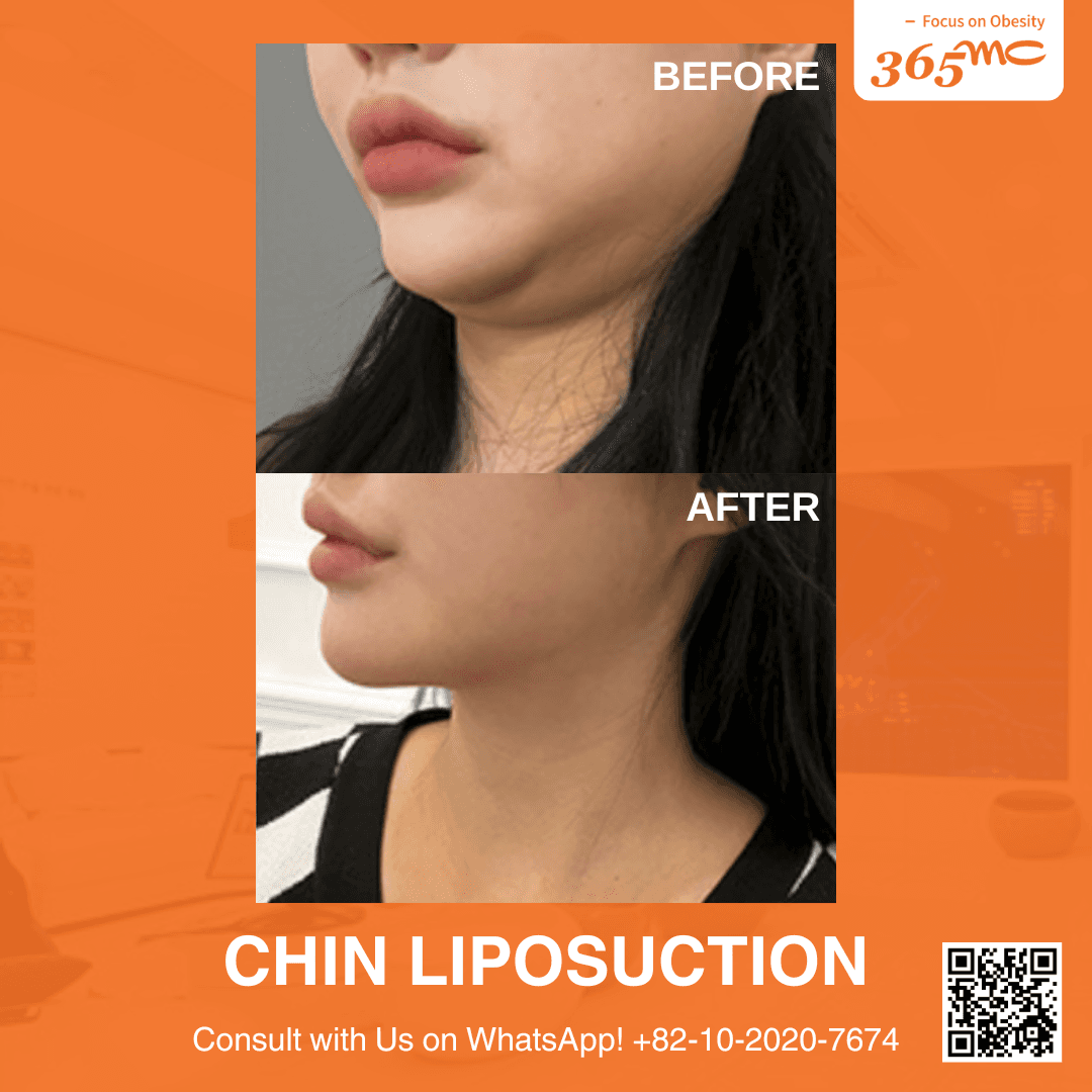 Before and After undefined