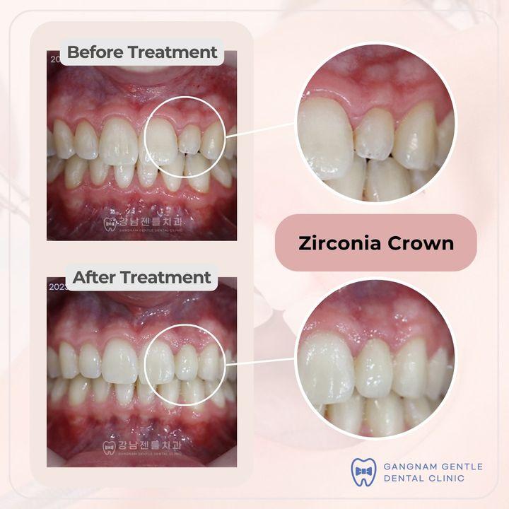 Before and After Teeth Crown