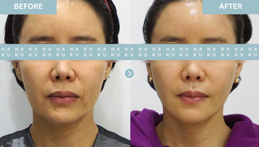 Before and After Lip Fillers
