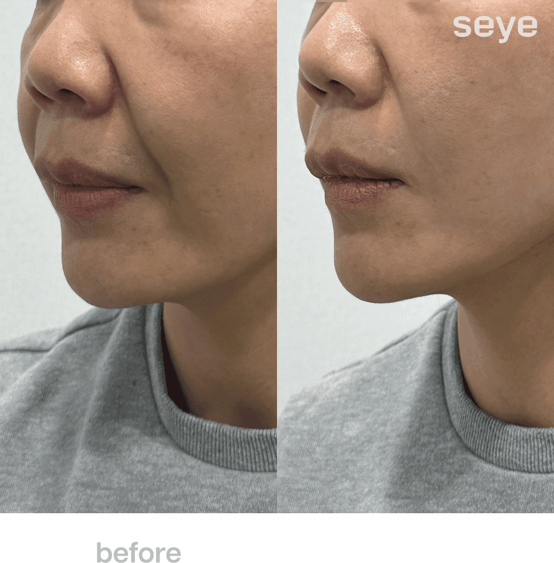 Before and After Thread Lift