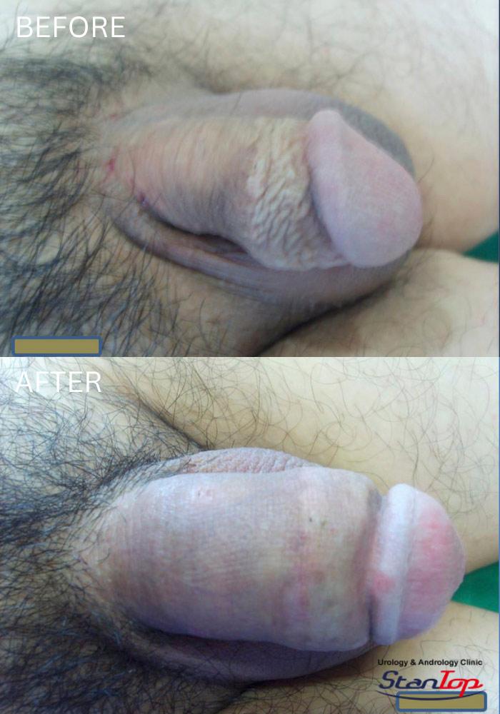 Before and After undefined