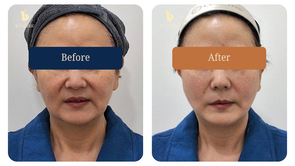 Before and After Thread Lift