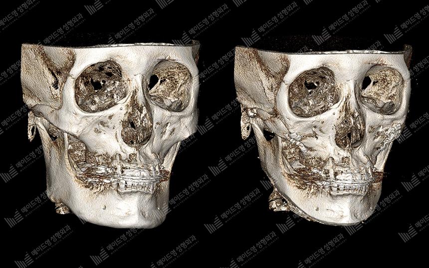 Before and After Face Contouring