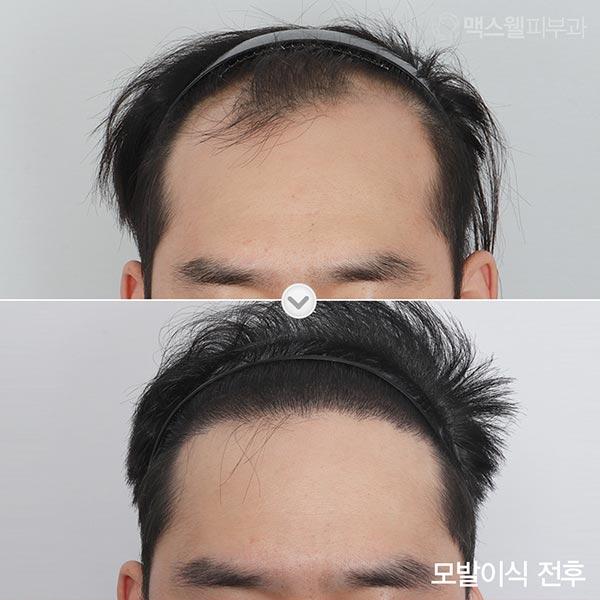 Before and After Hair Transplant