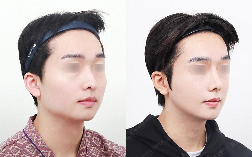 Before and After Face Contouring