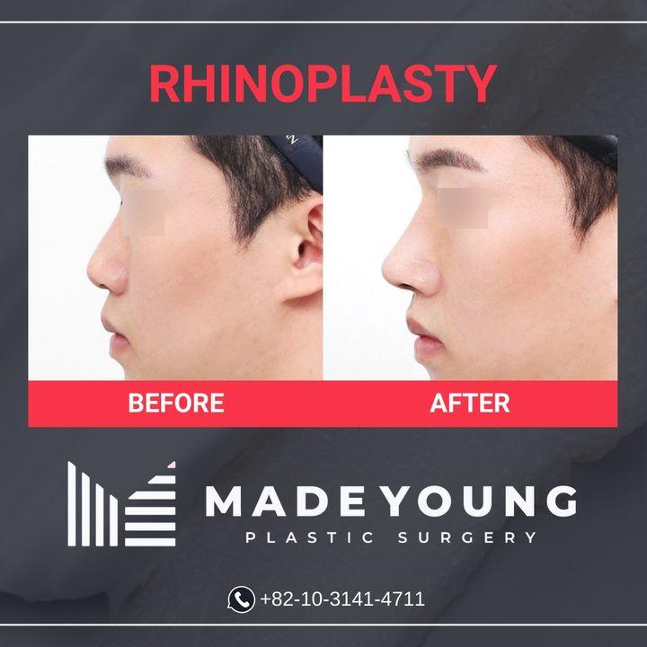 Before and After Rhinoplasty