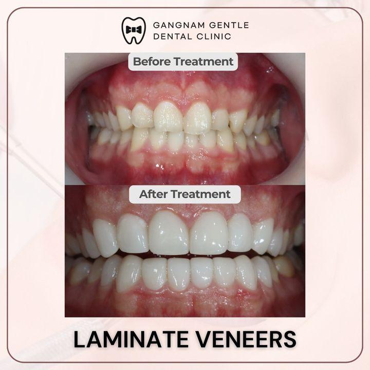 Before and After Veneers