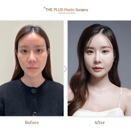 Before and After Cheekbone Reduction