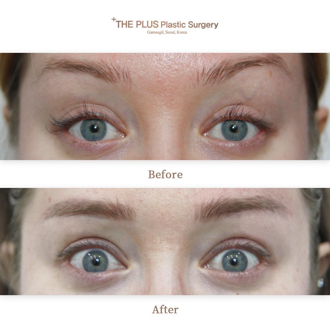 Before and After Subbrow Lift