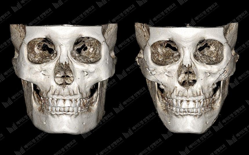 Before and After Face Contouring