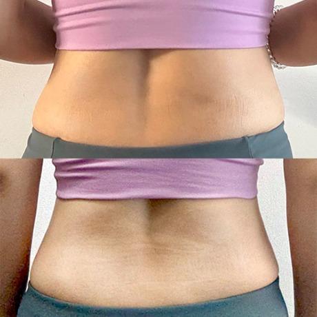 Before and After Fat Dissolving Injection