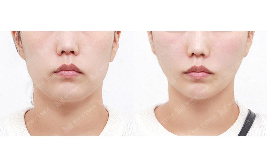 Before and After Face Lift