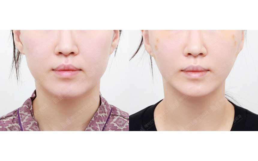 Before and After Face Lift