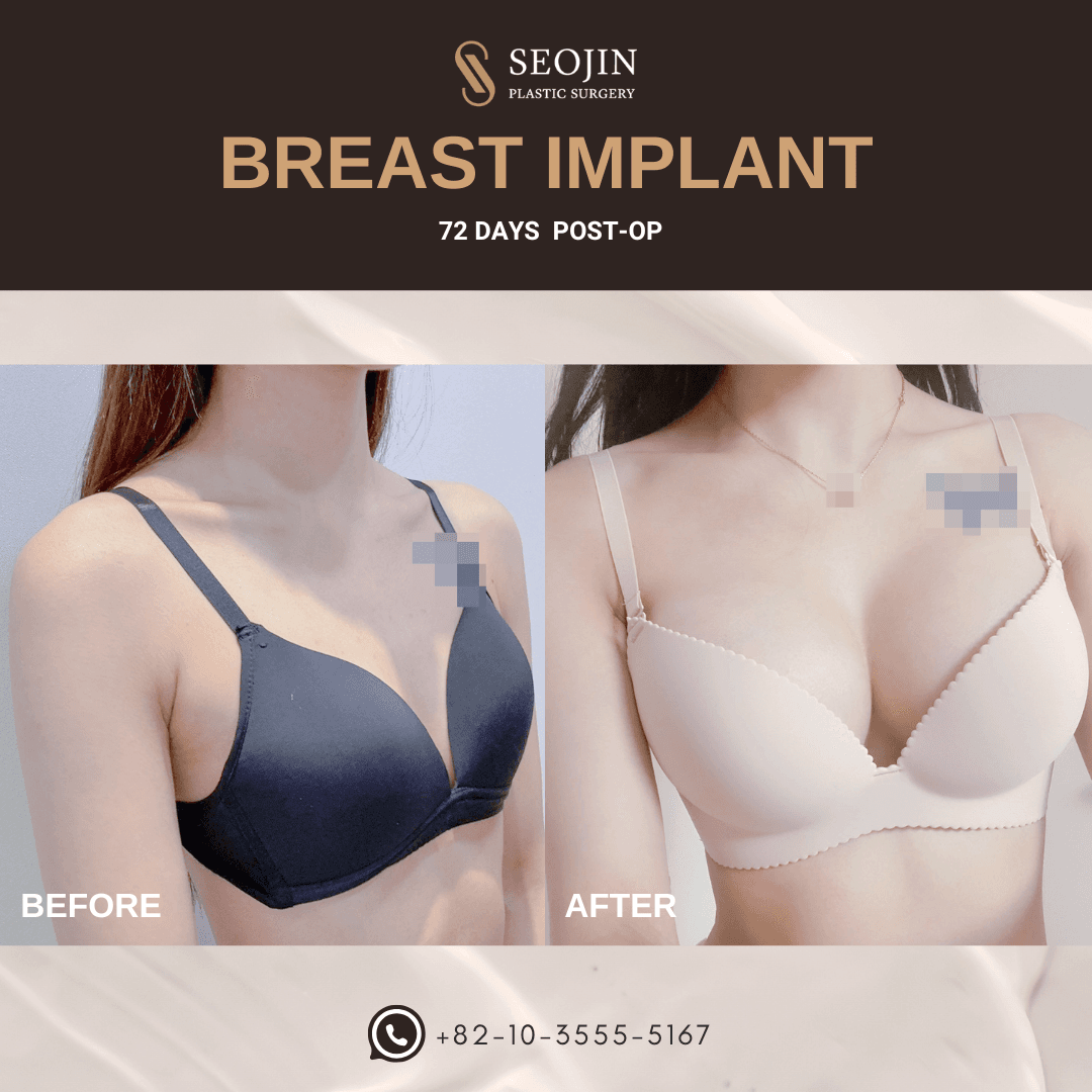Before and After Breast Implant