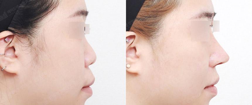 Before and After Rhinoplasty