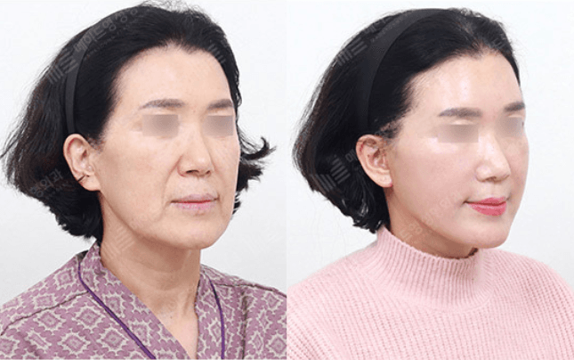Before and After Face Lift
