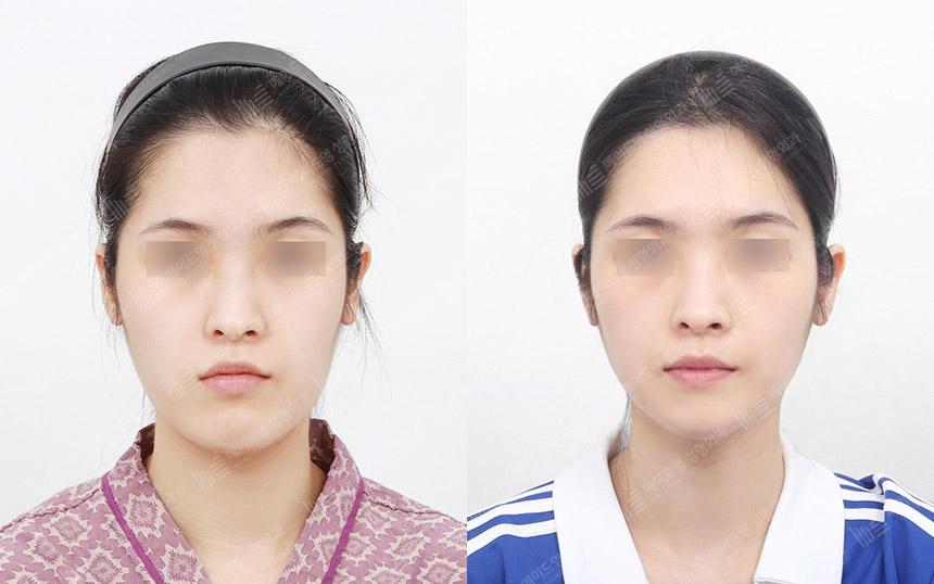 Before and After Face Contouring