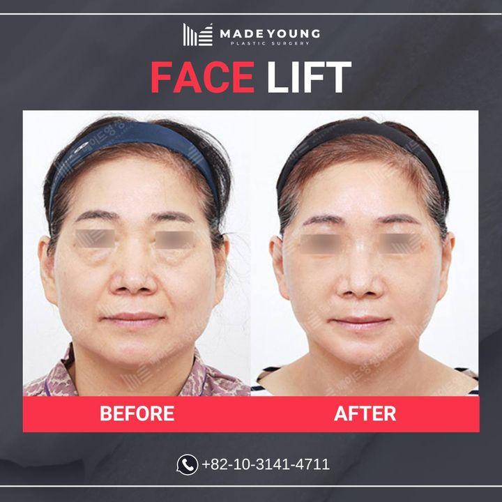Before and After Face Lift